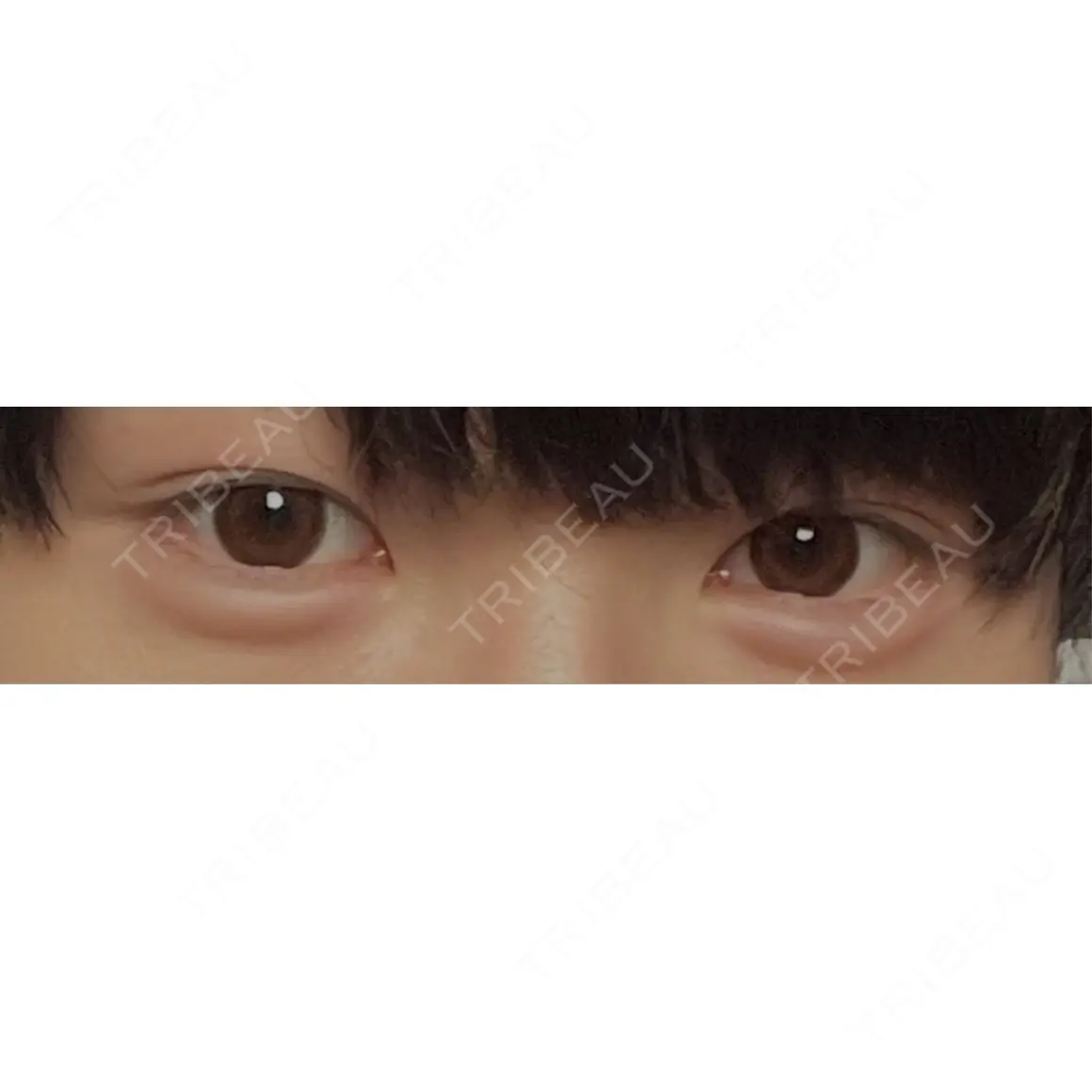 ヒアルロン酸注入（涙袋） PRO CLINIC プロクリニック 銀座院 AFTER