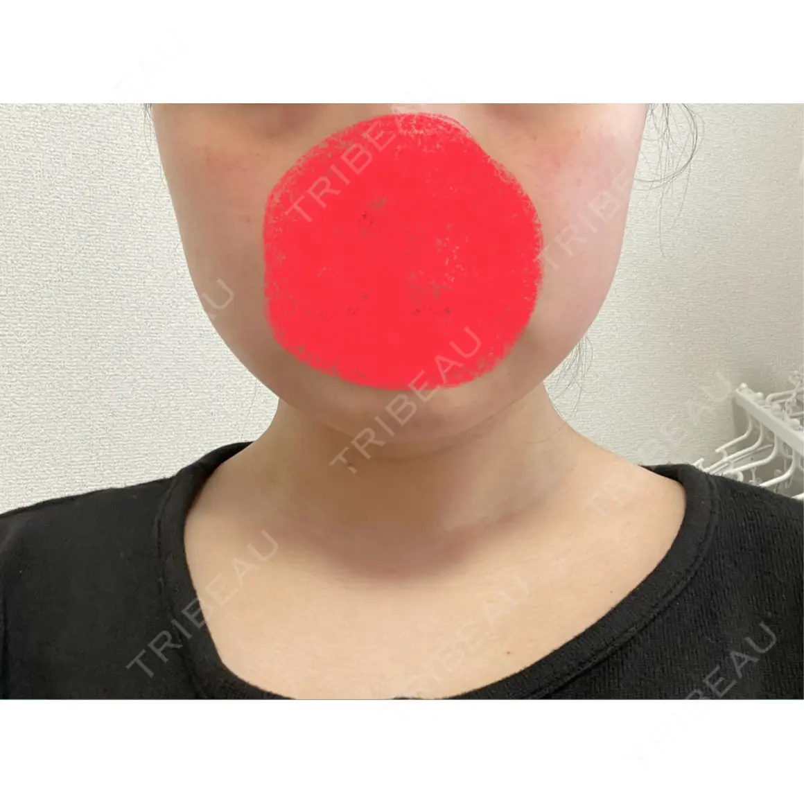 ボトックス（エラ・小顔） / ボトックス（肩） DMTC美容皮膚科 大宮院 DAY 0