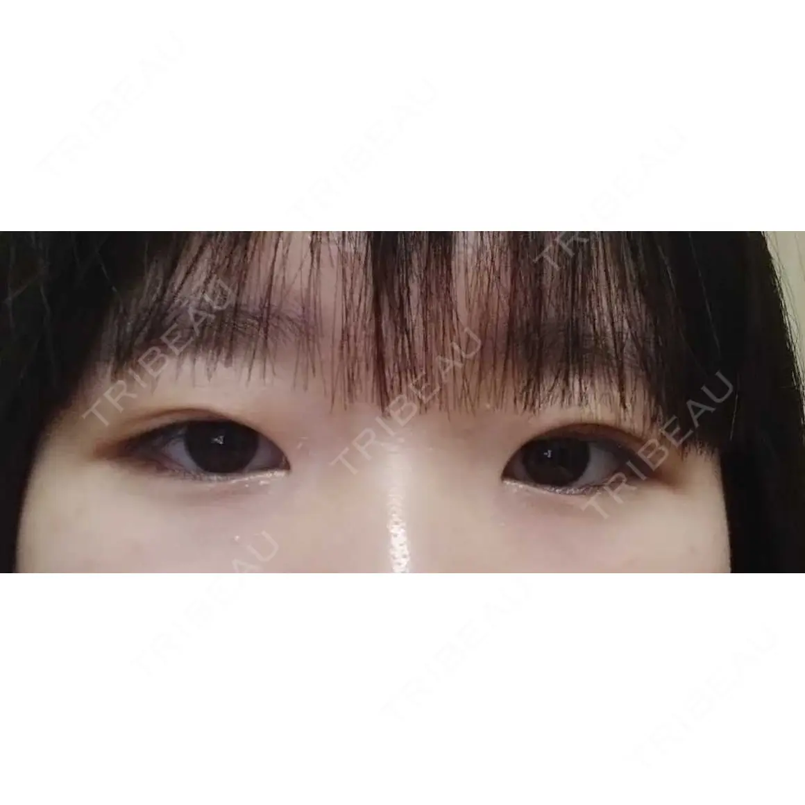 二重埋没 湘南美容クリニック 千葉センシティ院 AFTER