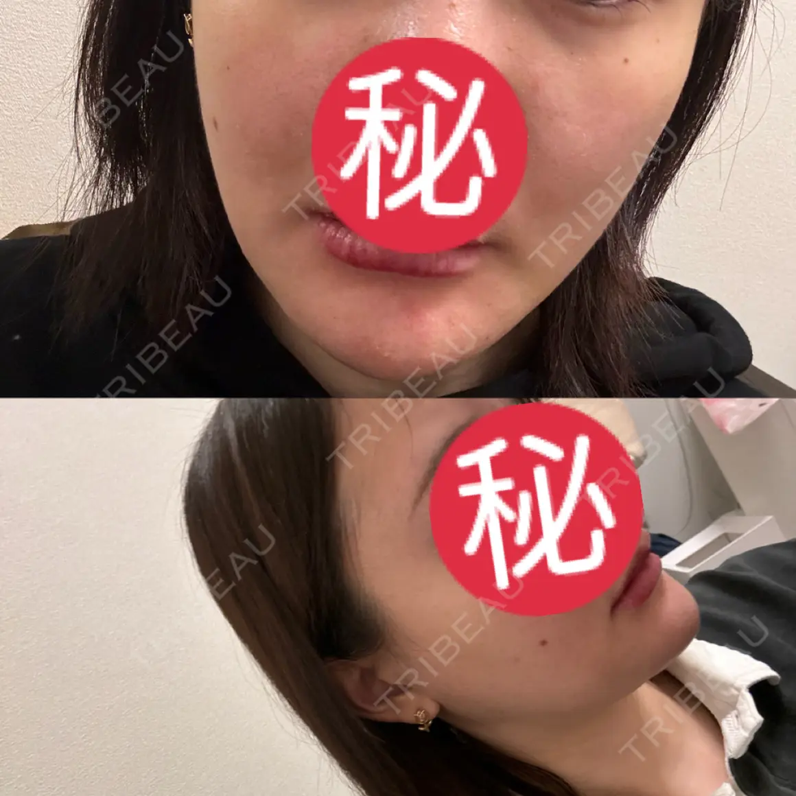 糸リフト / 脂肪吸引（顔） / 輪郭修正 / メーラーファット除去 / ジョールファット除去 / 脂肪吸引注射（顔） SEA CLINIC（シークリニック） AFTER