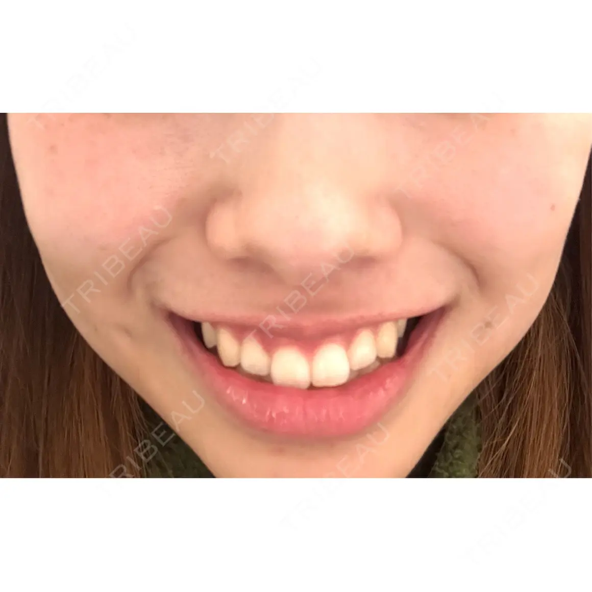 ボトックス（ガミースマイル） eクリニック 大阪梅田 西日本統括院 AFTER