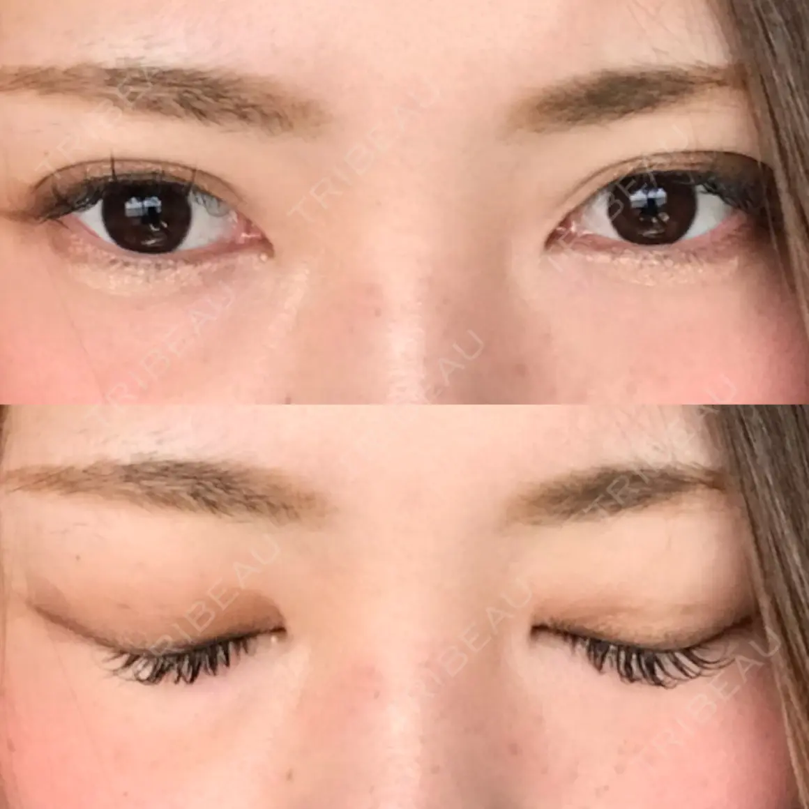 二重埋没 大阪梅田中央クリニック美容外科 AFTER