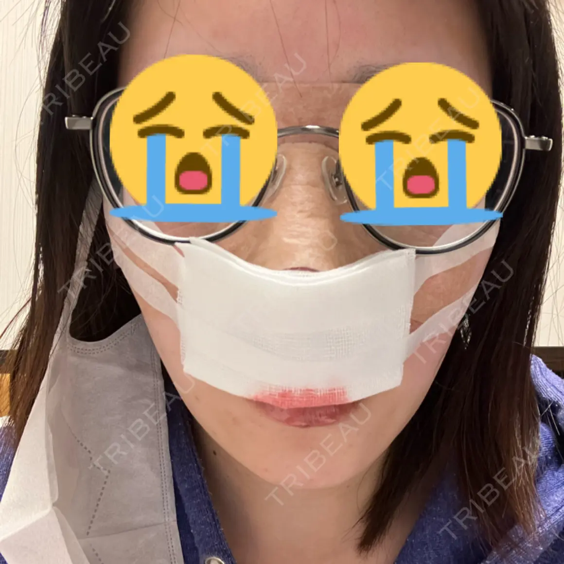 鼻尖形成（切開） / 鼻中隔延長（切開） / 軟骨移植 / ワシ鼻修正・ハンプ切除 4Dクリニック DAY 0