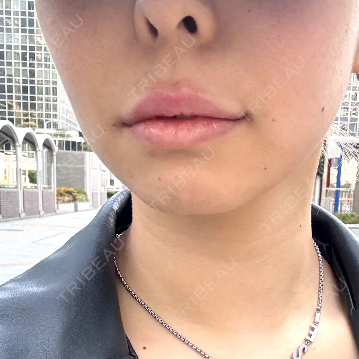 ヒアルロン酸注入（涙袋） / ヒアルロン酸注入（唇） / ボトックス（口角） HAAB×DREAM BEAUTY CLINIC 大阪梅田院 AFTER