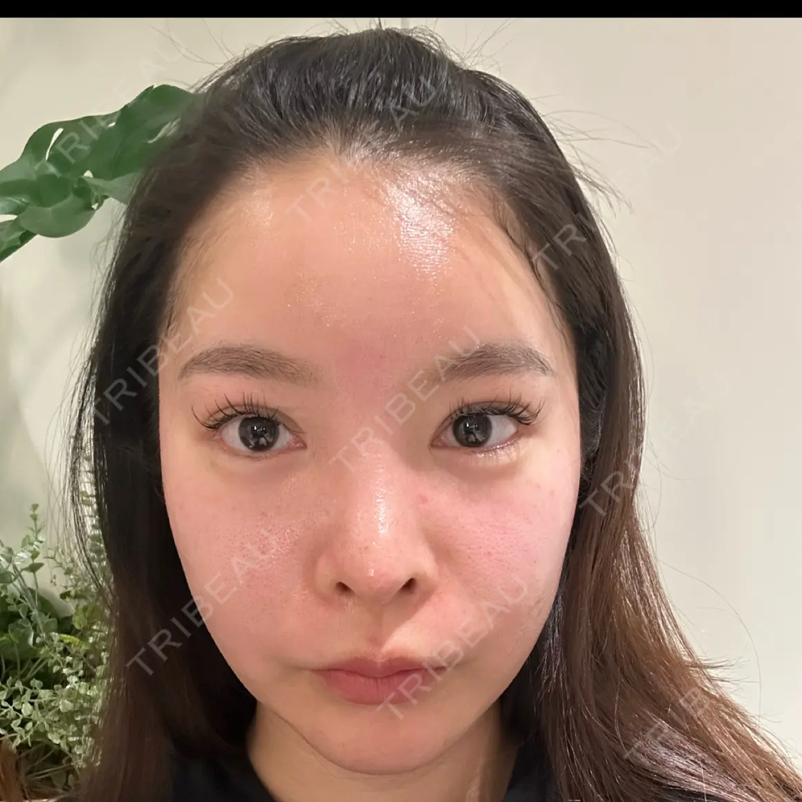 ポテンツァ 9BeautyClinic DAY 0