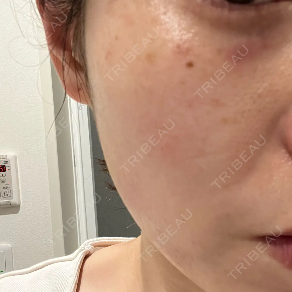 ピーリング（ハリ・ツヤ） GLAMRULE CLINIC (グラムルール クリニック) 銀座院 DAY 0