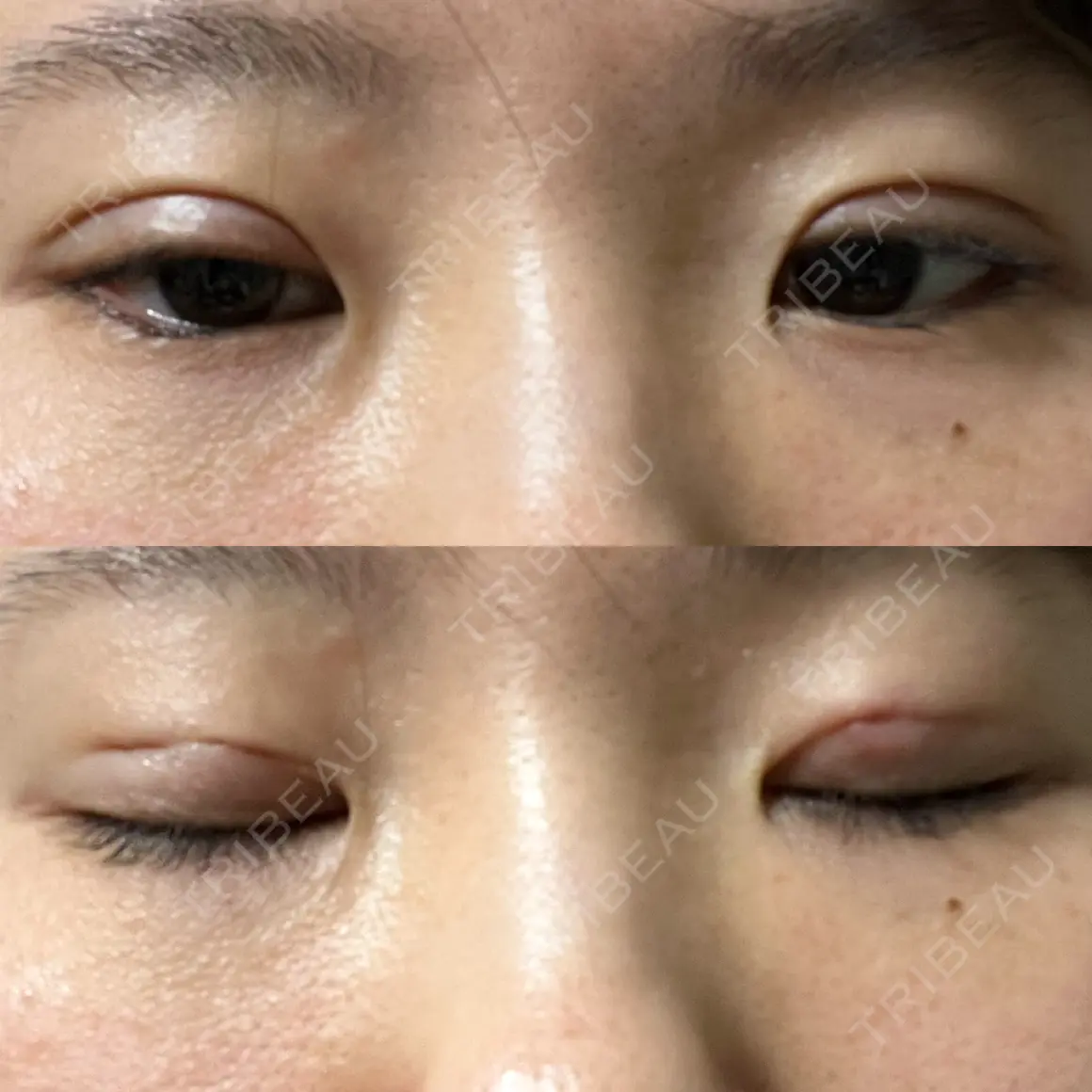 二重埋没 ルラ美容クリニック 高田馬場院 DAY 0