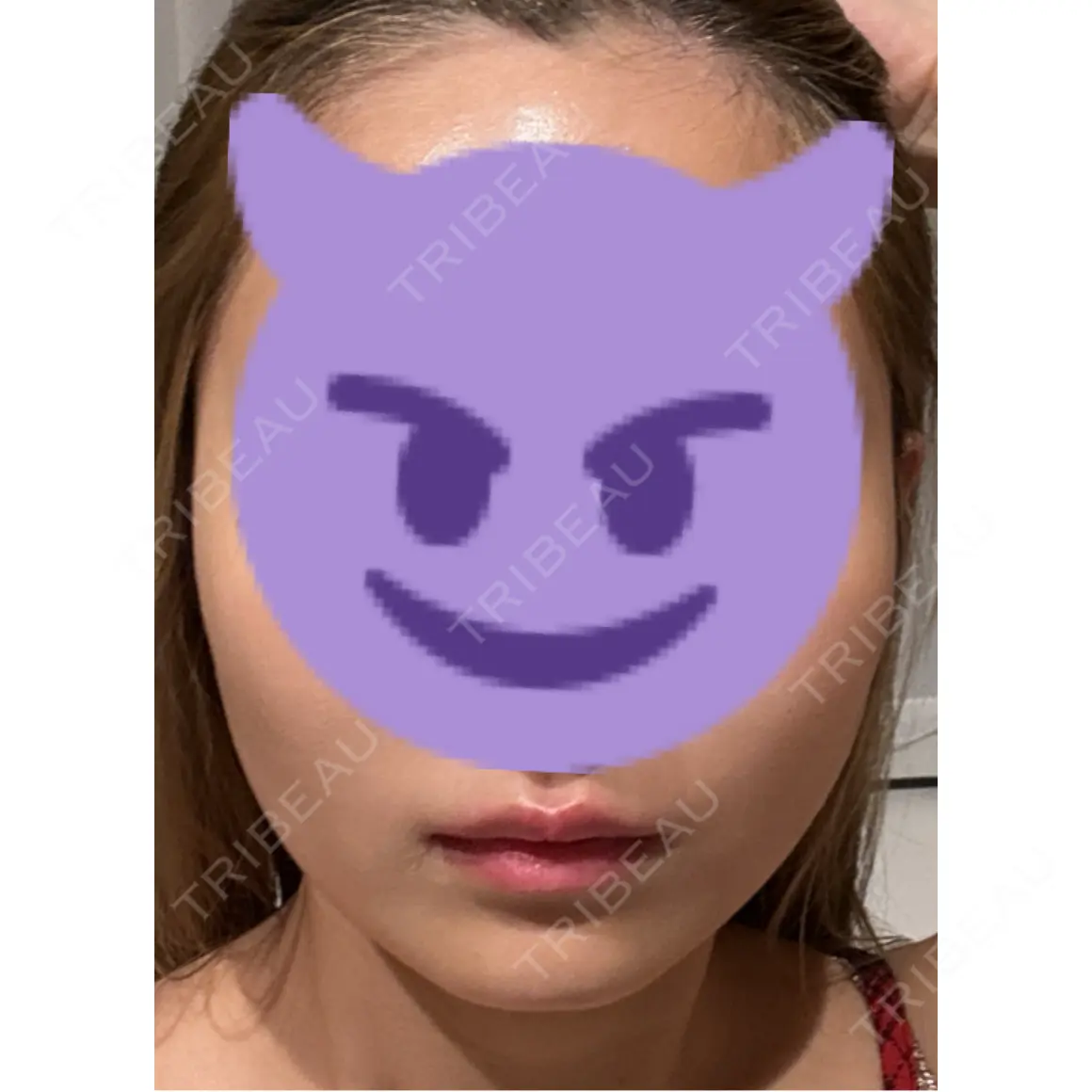 ボトックス（エラ・小顔） AYANAフィラーズクリニック 渋谷院 DAY 0