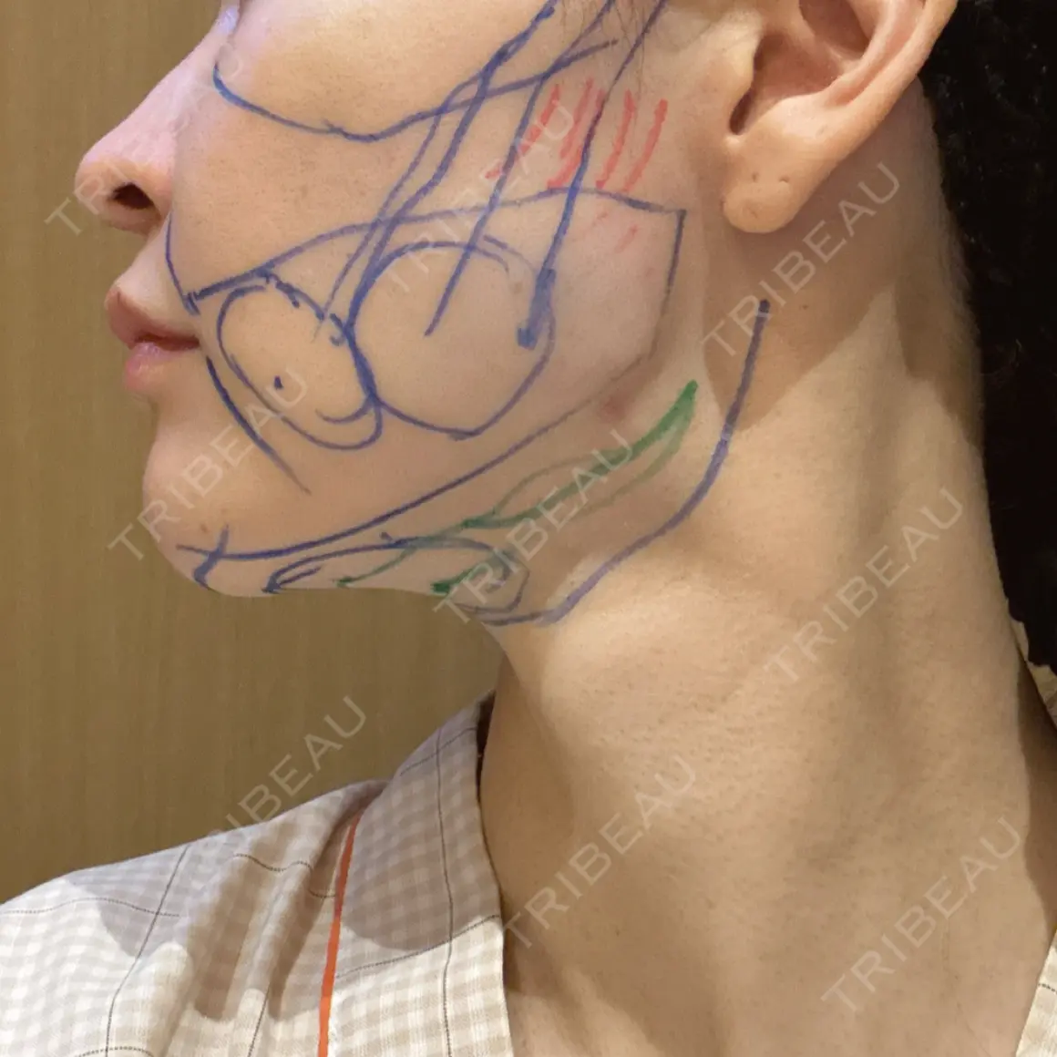 糸リフト / バッカルファット除去 / 脂肪吸引（顔） / ジョールファット除去 ICON CLINIC DAY 0