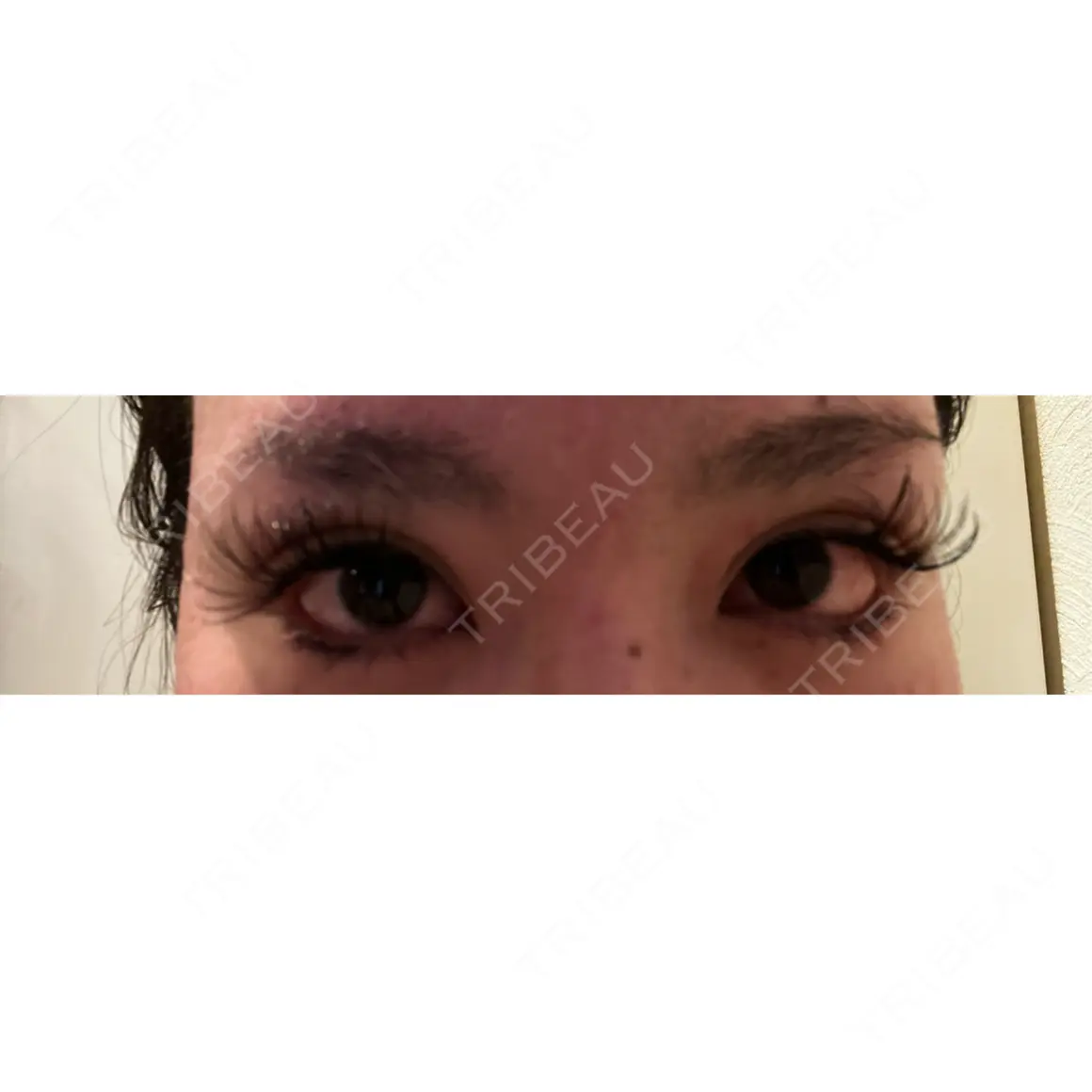 二重埋没 / 目尻切開 / 下まぶたの脂肪取り / タレ目形成・グラマラスライン（切開） / 目尻靭帯移動 エターナル美容クリニック AFTER
