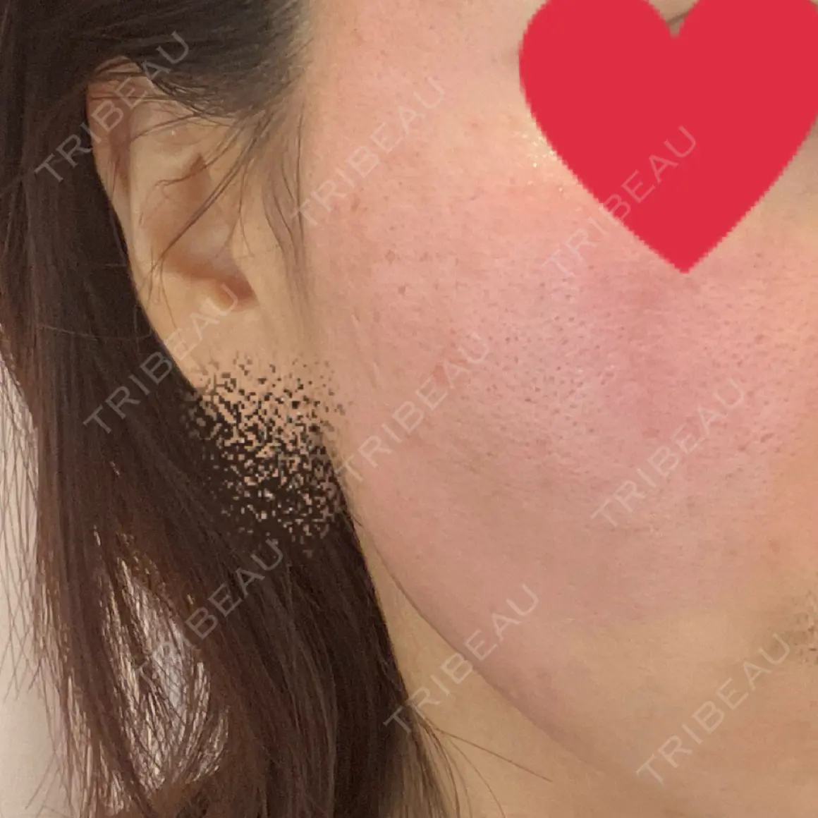 ポテンツァ 美容皮膚科 デュークリニック DAY 0