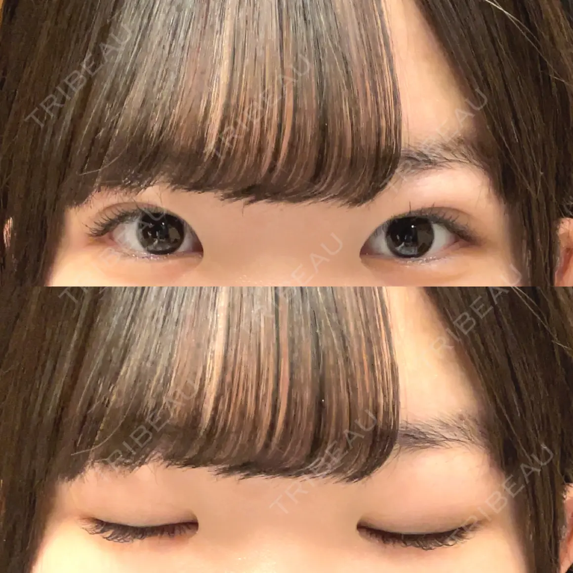 二重埋没 湘南美容クリニック 千葉センシティ院 AFTER