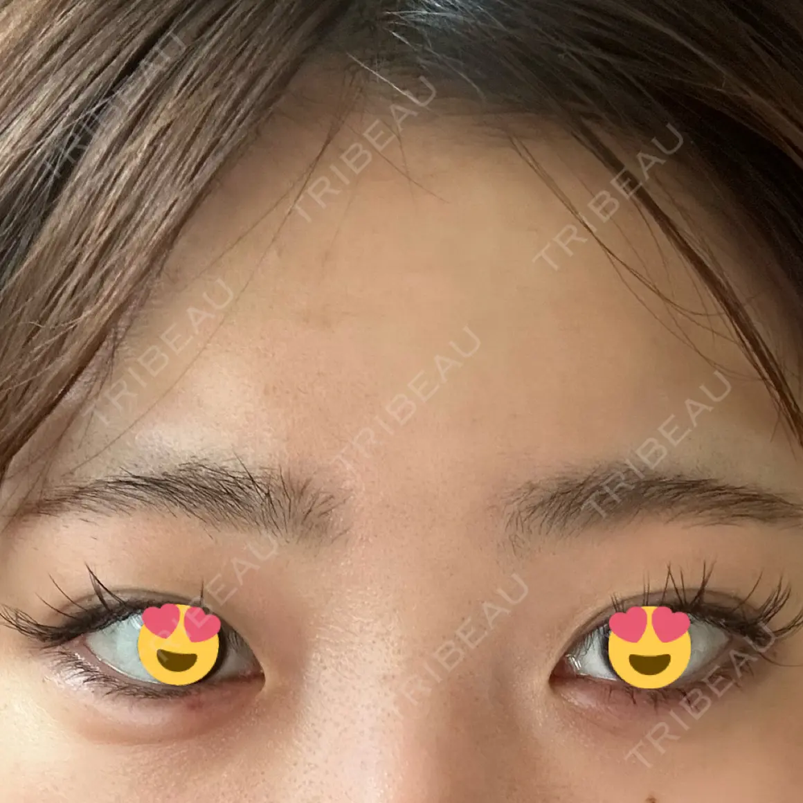 ヒアルロン酸注入（涙袋） Code Beauty Clinic 名古屋院 DAY 0