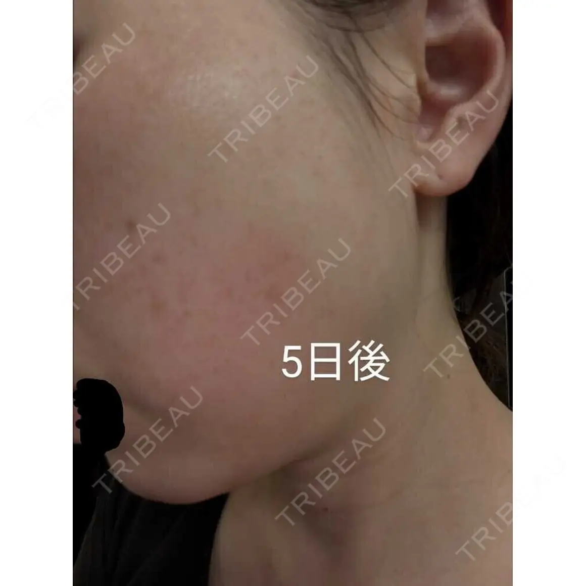 ルビーレーザー AZ BEAUTY CLINIC AFTER