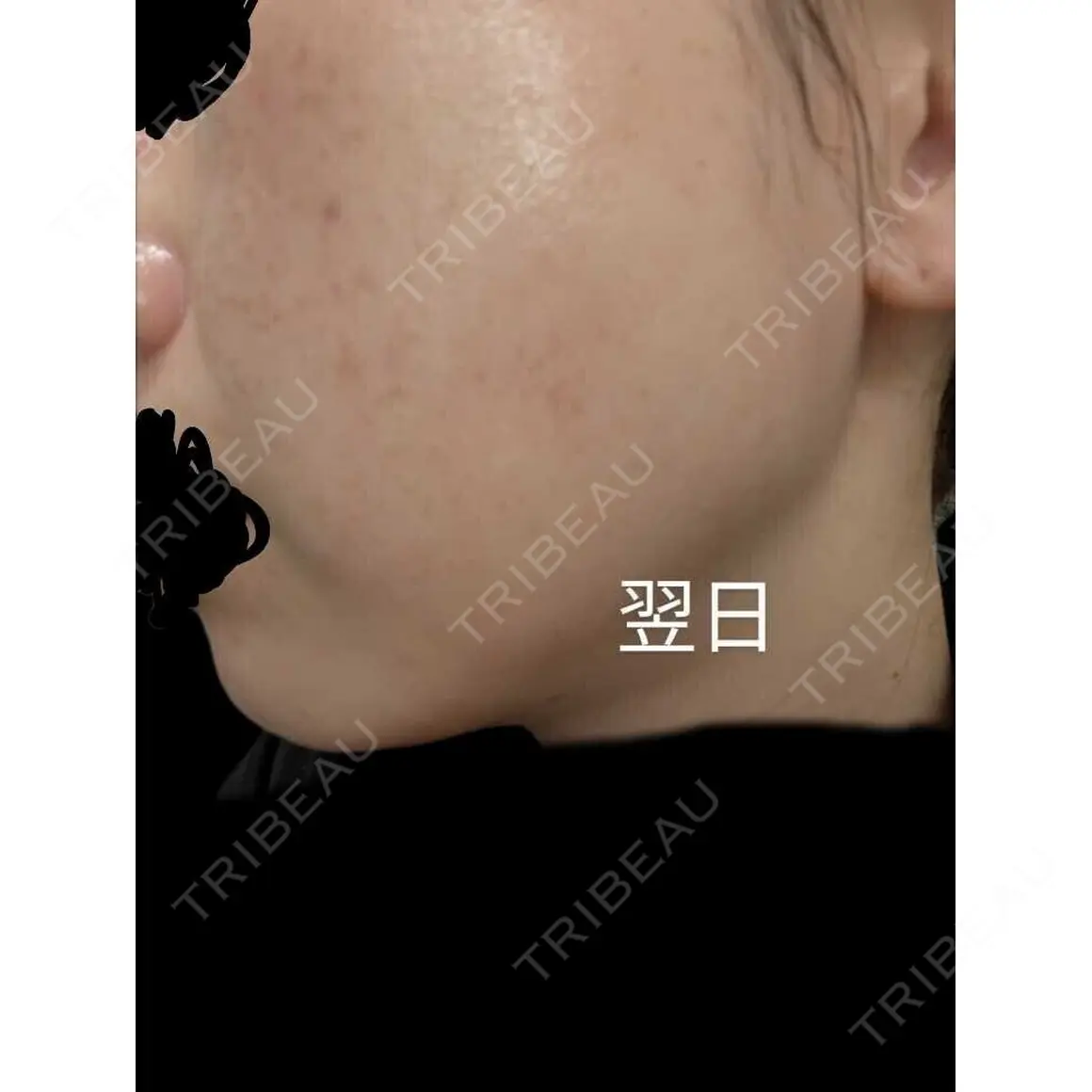 ルビーレーザー AZ BEAUTY CLINIC AFTER