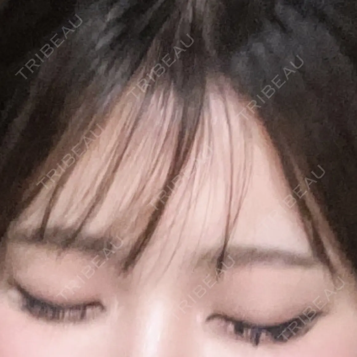 ヒアルロン酸注入（涙袋） Code Beauty Clinic 名古屋院 AFTER