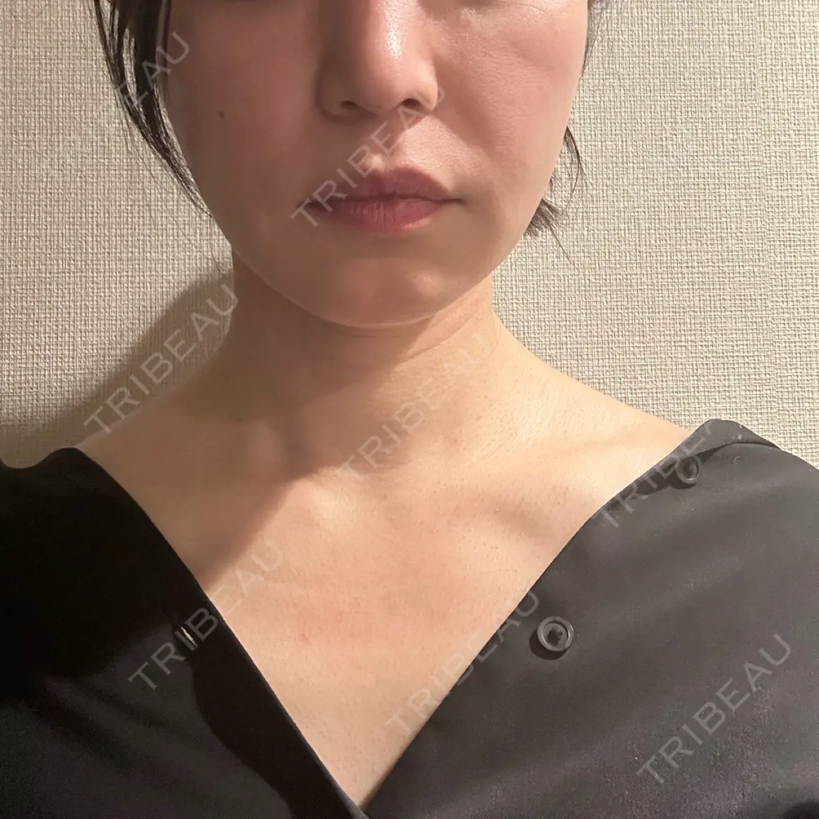 ボトックス（肩） 新未来クリニック AFTER