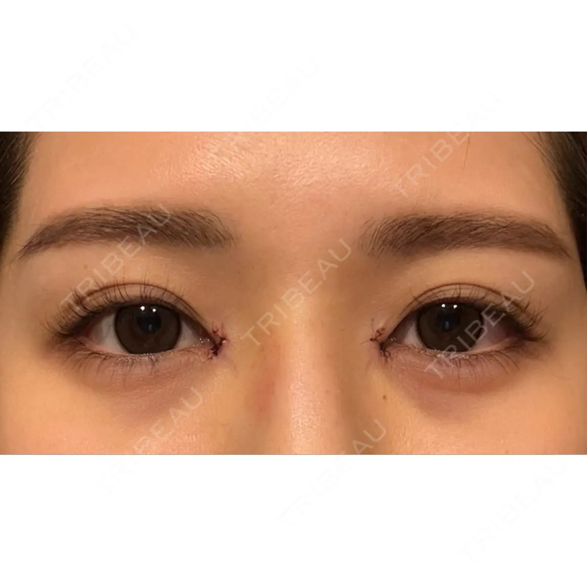 目頭切開 Çà et Là Clinique（さえらクリニック） DAY 0