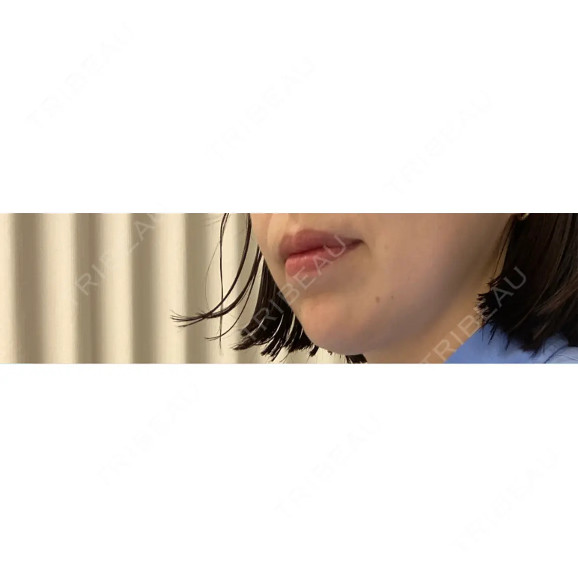 ボトックス（あご） / ボトックス（ガミースマイル） eクリニック 岡山院 AFTER