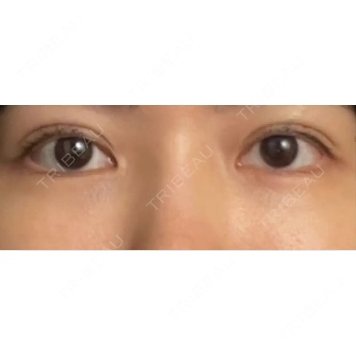 クマ治療 EMMO FACE CLINIC 東京三田院 AFTER