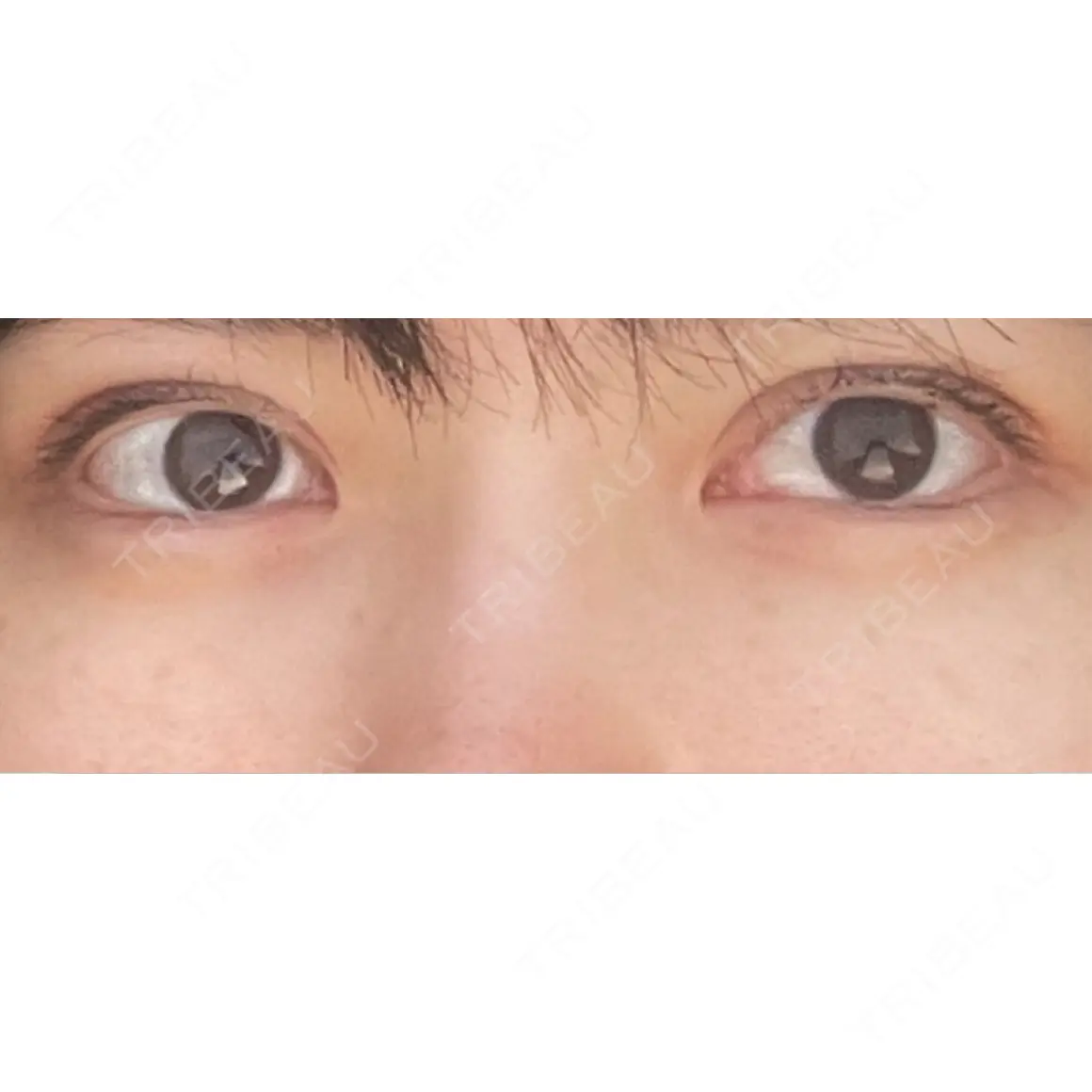 クマ治療 EMMO FACE CLINIC 東京三田院 AFTER