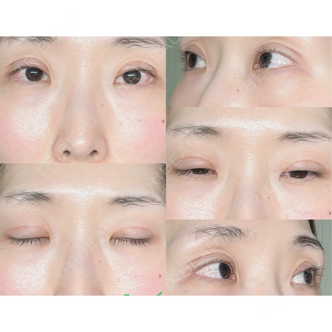 二重切開 / 眼瞼下垂（切開） / 上まぶたの脂肪取り オーキッド美容クリニック東京御徒町 AFTER
