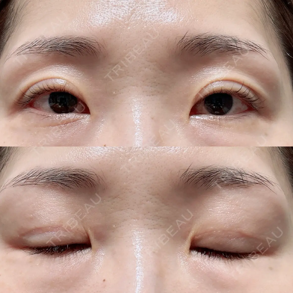 二重切開 / 眼瞼下垂（切開） / 上まぶたの脂肪取り オーキッド美容クリニック東京御徒町 AFTER