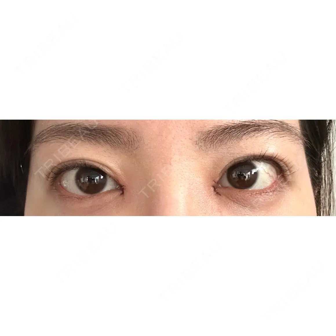 目頭切開 HAAB×DREAM BEAUTY CLINIC 東京本院 DAY 0