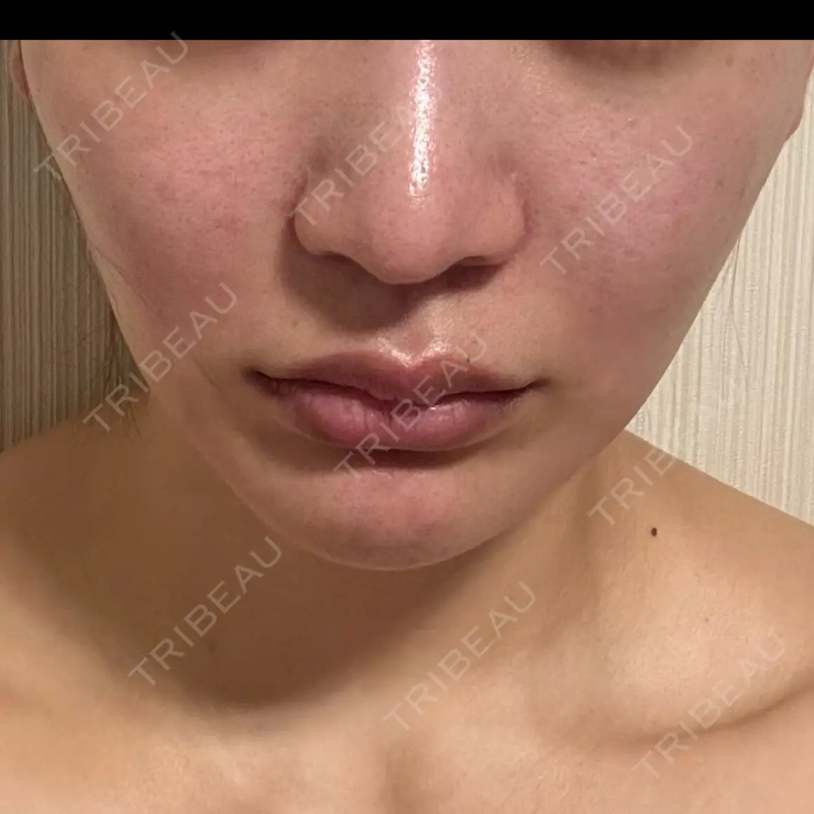 糸リフト 9BeautyClinic DAY 0