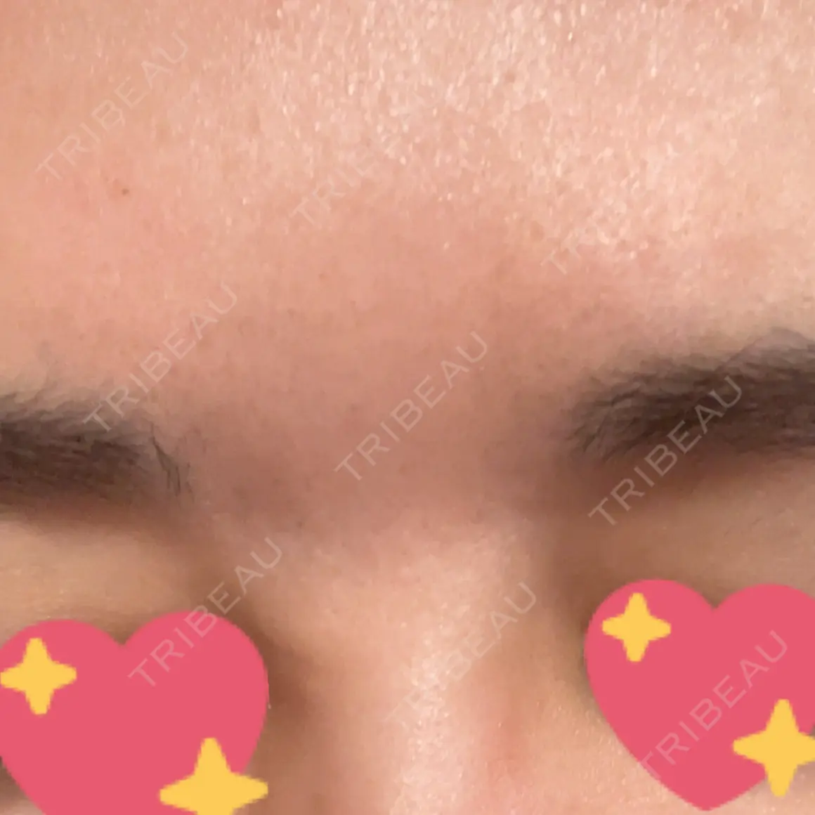 ボトックス（眉間） WellnessPlus Clinic 【ウェルネスプラスクリニック】 AFTER