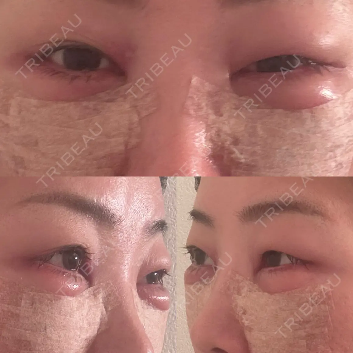 クマ治療 EMMO FACE CLINIC 東京三田院 DAY 1