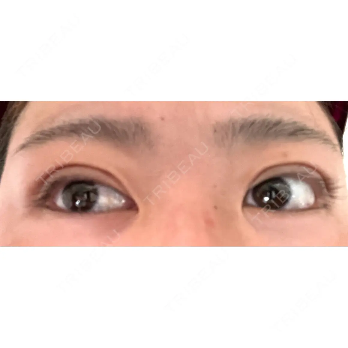 自然癒着法 CLINIC W DAY 0