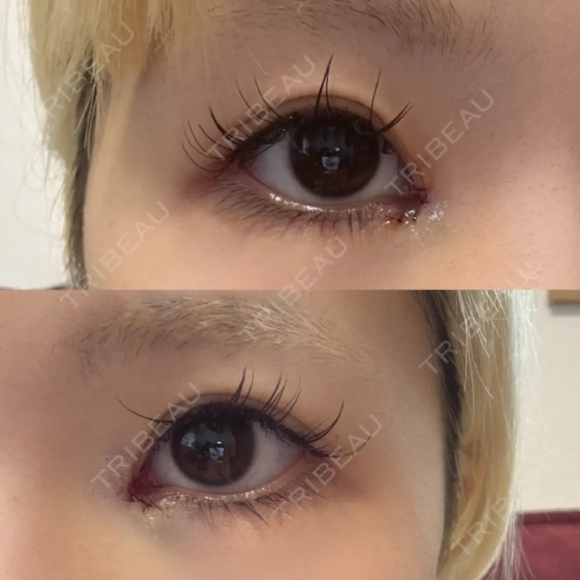目頭切開 9BeautyClinic DAY 0
