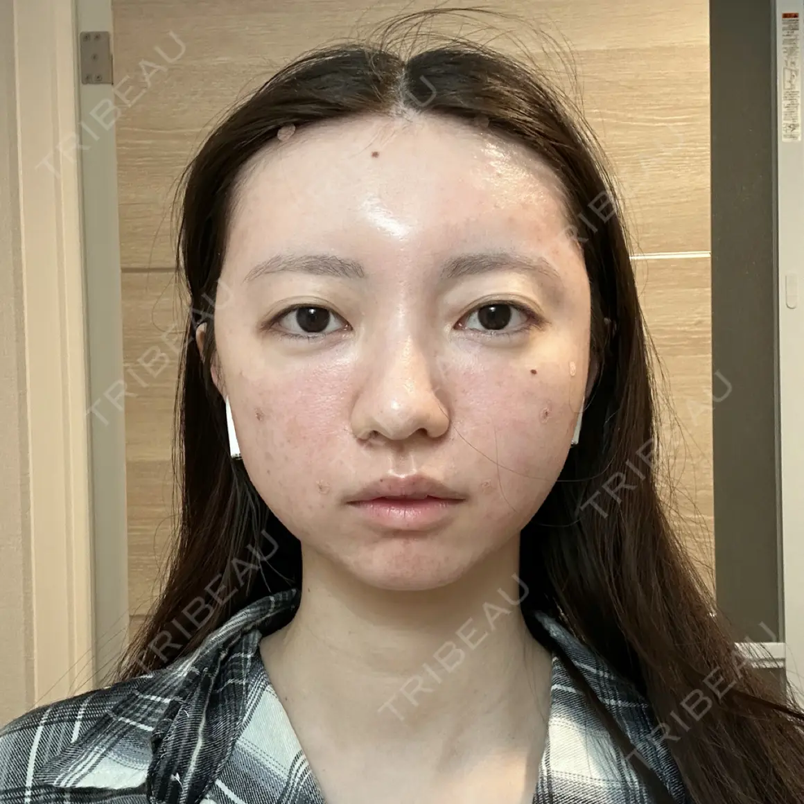脂肪注入（肌） / 脂肪注入（額） / 脂肪注入（目の下） ルーチェクリニック 銀座院 DAY 0