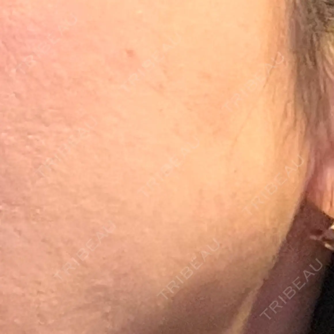 水光注射（ハリ・美肌） GLAMRULE CLINIC (グラムルール クリニック) 銀座院 AFTER