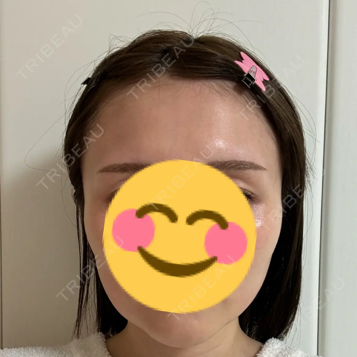 ボトックス（エラ・小顔） 東京形成美容外科 銀座院 AFTER