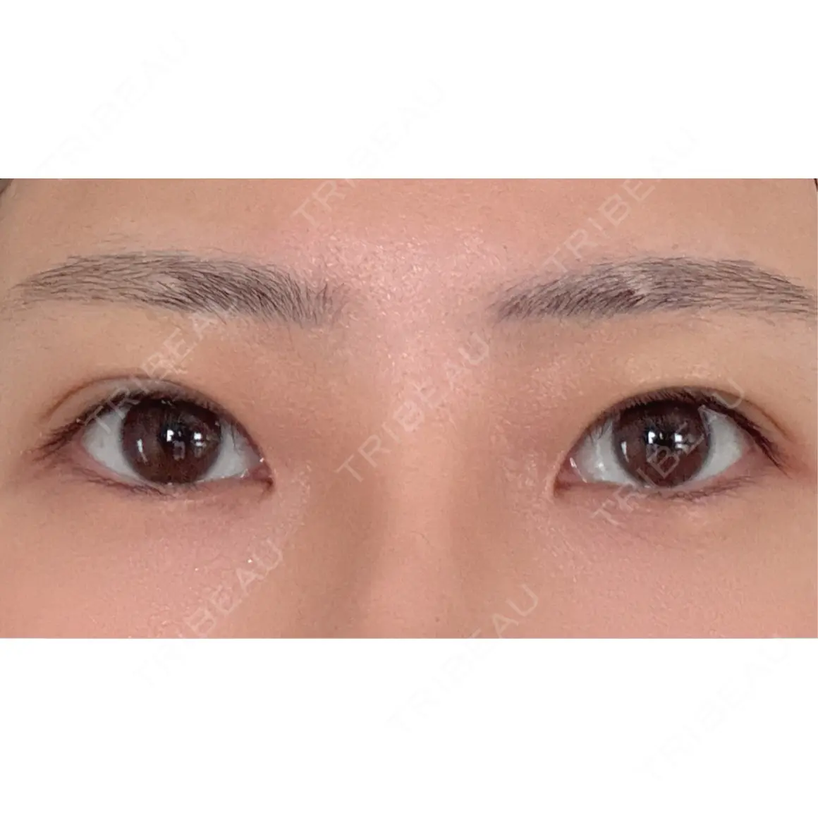 二重埋没 オアシス美容外科 AFTER