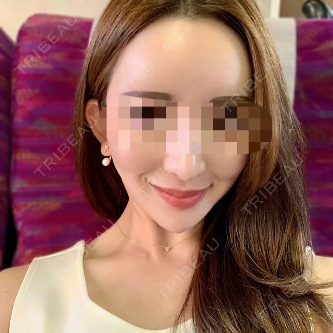 ハイフ（顔） DAILY SKIN CLINIC 福岡院 AFTER