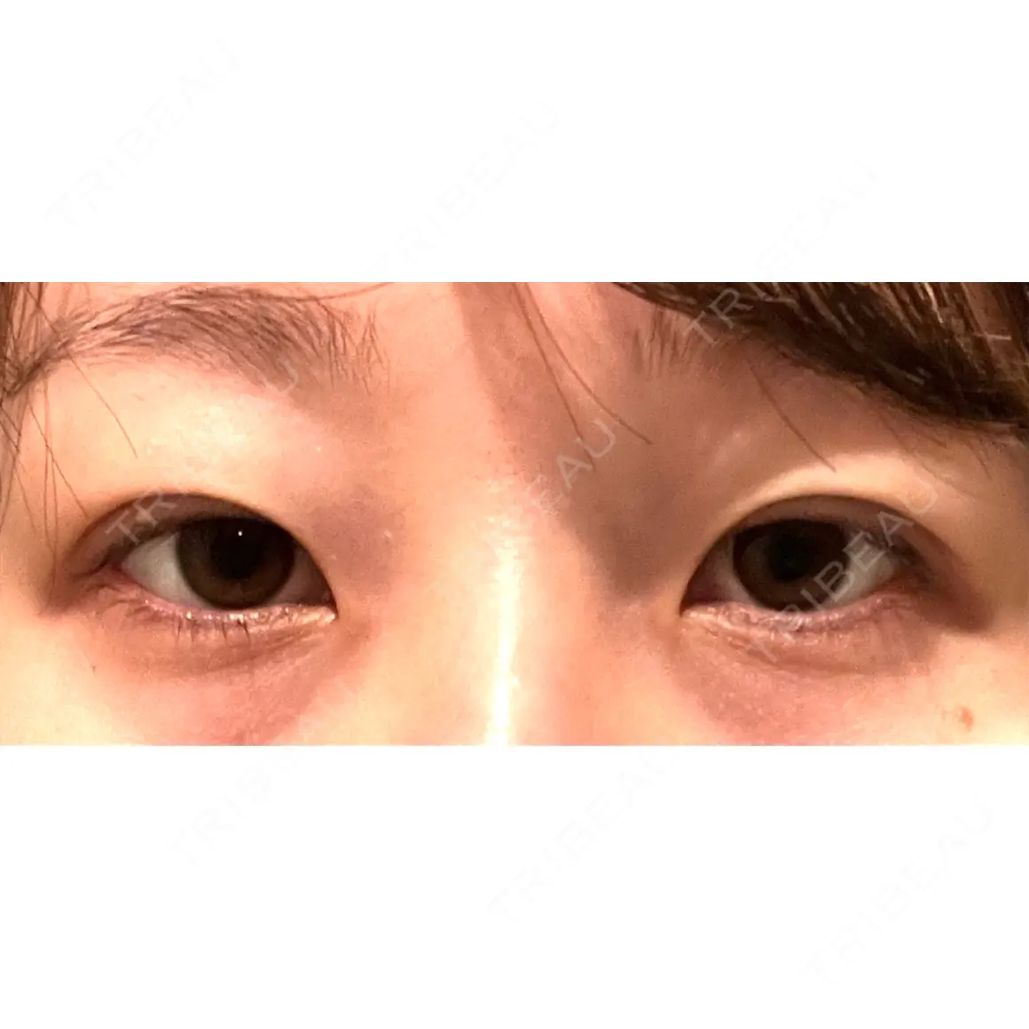 二重埋没 湘南美容クリニック 千葉センシティ院 DAY 0