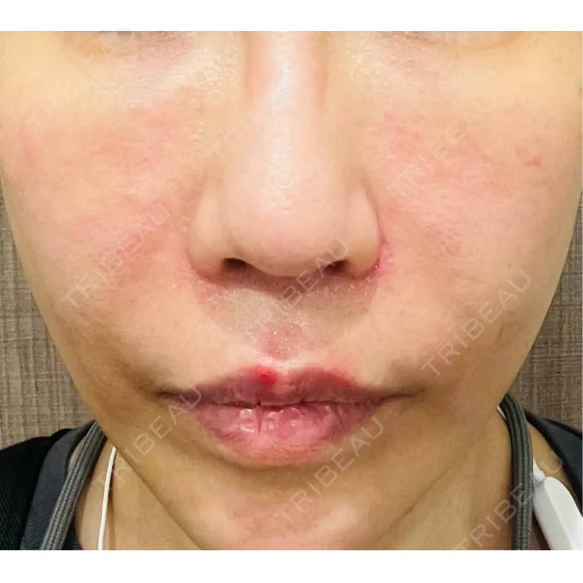赤み除去レーザー B-LINE CLINIC 池袋院 DAY 0