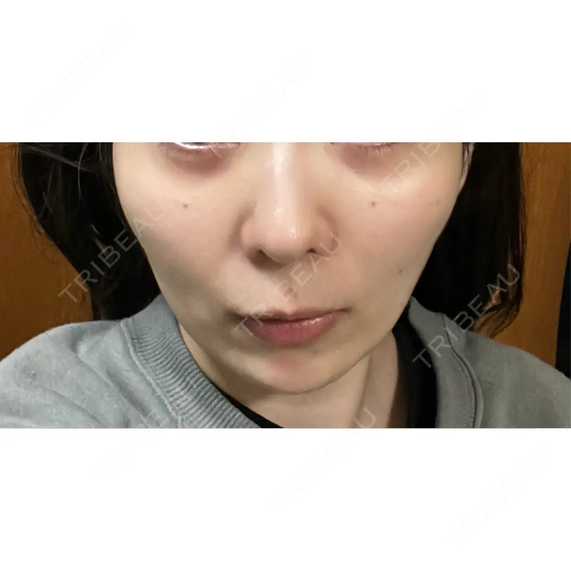 美肌レーザー まゆりなclinic 名古屋栄 DAY 1