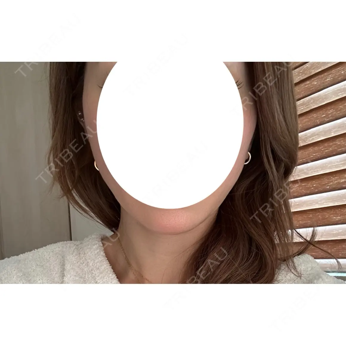 糸リフト Stand by Beauty Clinic DAY 3