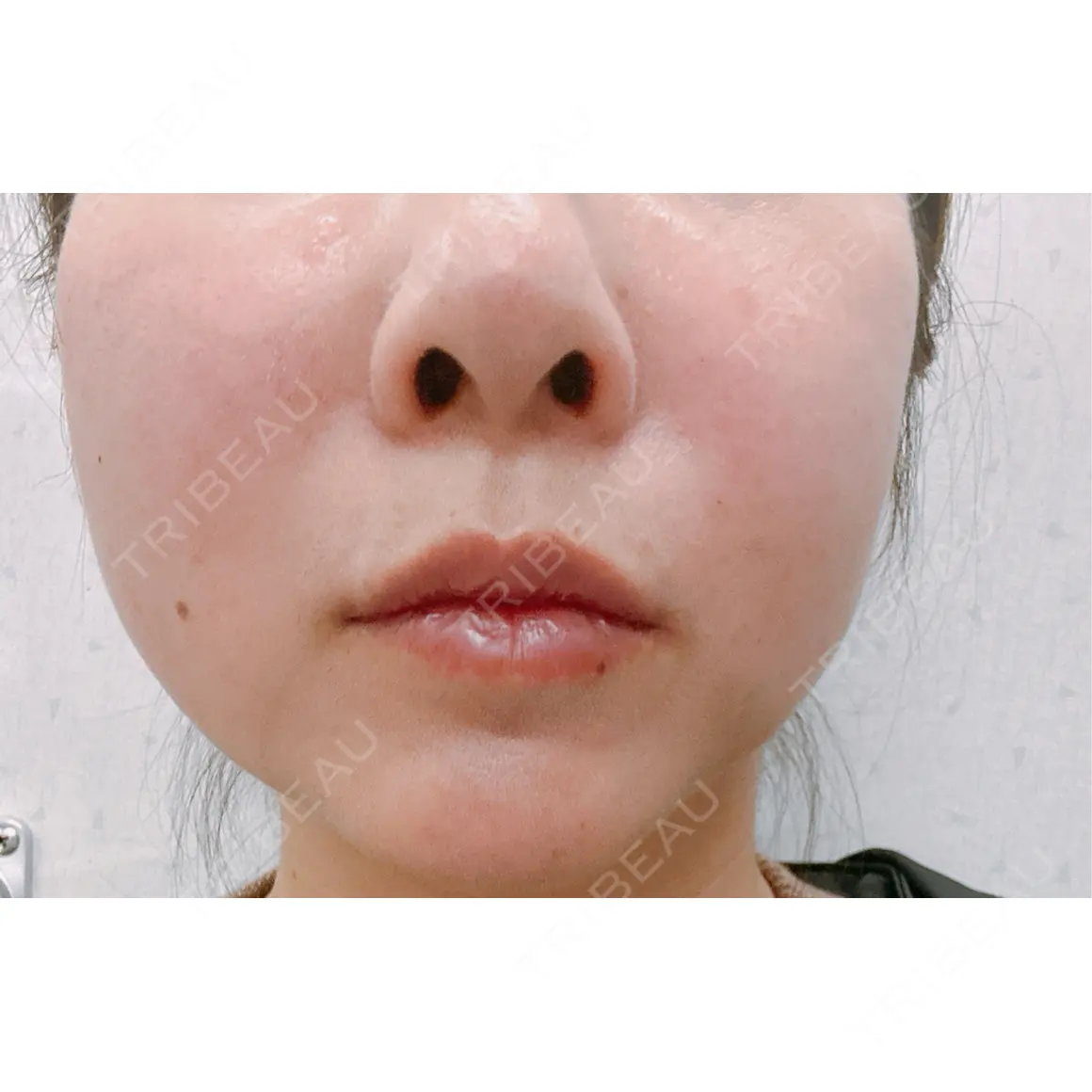 脂肪溶解注射（顔） Nクリニック伏見 DAY 0