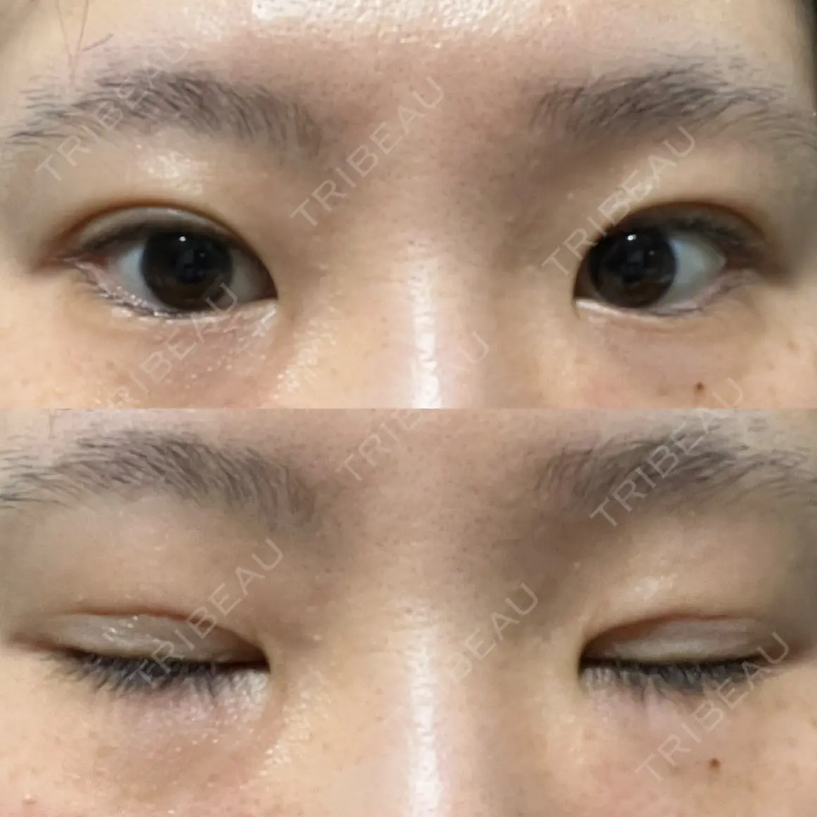 二重埋没 ルラ美容クリニック 高田馬場院 AFTER