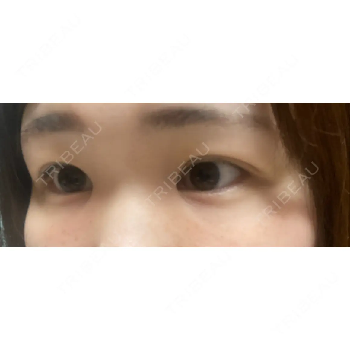 クマ治療 TCB東京中央美容外科 前橋院 AFTER