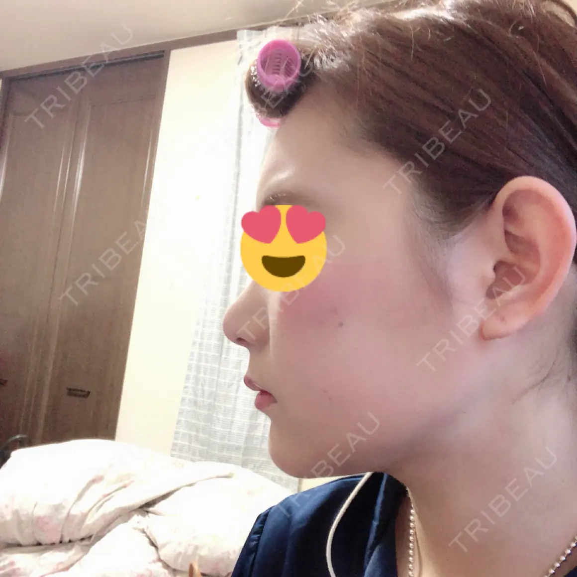 バッカルファット除去 / 脂肪吸引（顔） / その他（輪郭） フレッシュ整形外科 AFTER