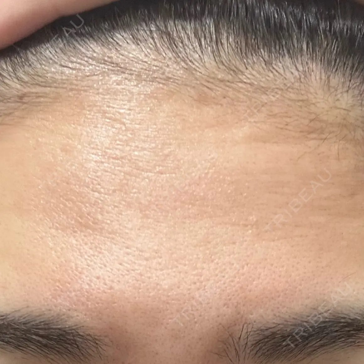 ボトックス（額） WellnessPlus Clinic 【ウェルネスプラスクリニック】 AFTER