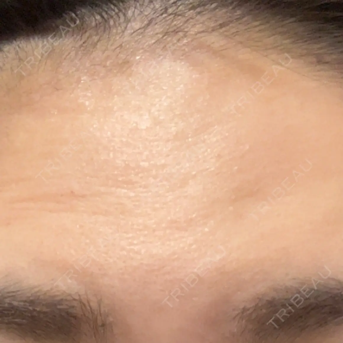 ボトックス（額） WellnessPlus Clinic 【ウェルネスプラスクリニック】 AFTER