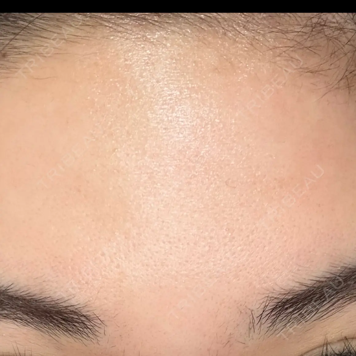 ボトックス（額） WellnessPlus Clinic 【ウェルネスプラスクリニック】 AFTER