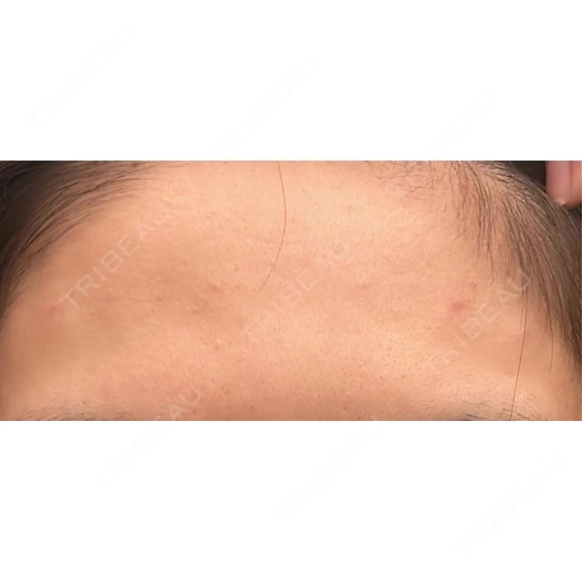 ボトックス（額） WellnessPlus Clinic 【ウェルネスプラスクリニック】 DAY 0
